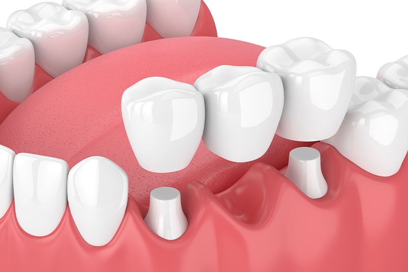 Dental Bridges in Indianapolis