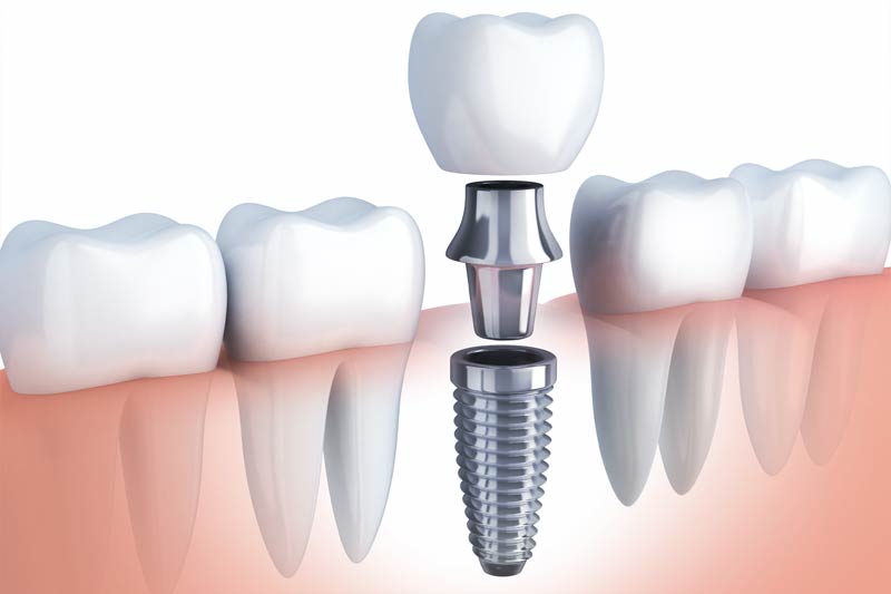 Dental Implants in Indianapolis