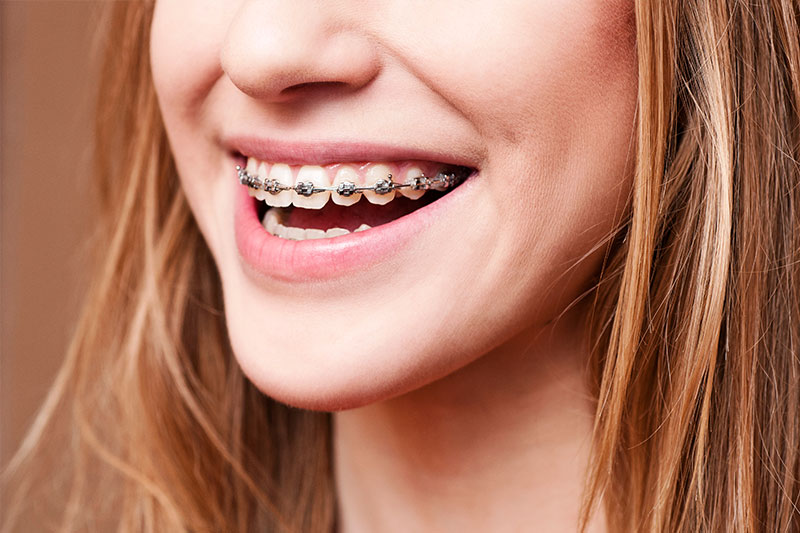 Orthodontics in Indianapolis